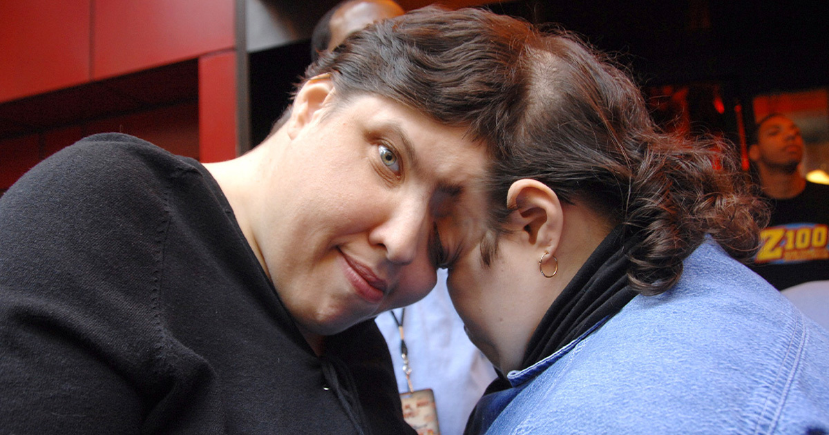 Conjoined Twins: Lori and George Schappell
